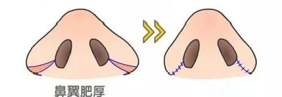 鼻头缩小鼻翼缩小前后对比图,鼻头缩小跟缩小鼻翼有区别吗