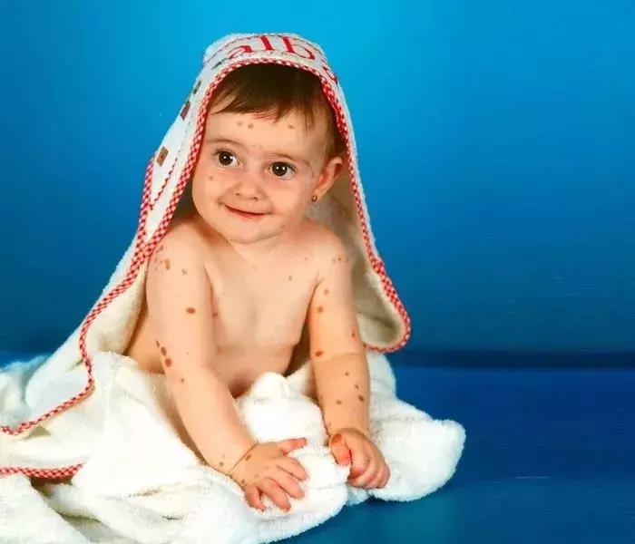 全身黑斑被骂“斑点狗”，身高160的她却成为最美超模…