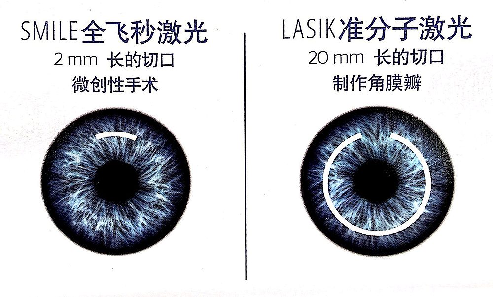 戴隐形眼镜能不能做近视散光手术,隐形眼镜可以近视加散光吗