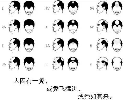 我国2.5亿人“秃了”,科学家找到“元凶”后反而更苦恼,咋回事