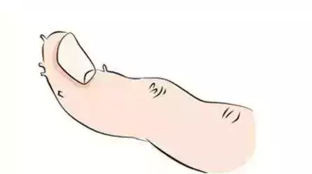 手指甲起倒刺缺维生素什么,手指甲倒刺缺维生素