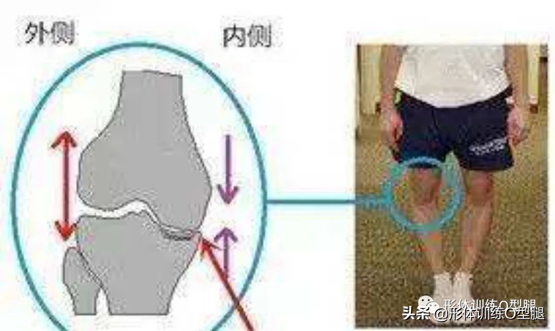o型腿和罗圈腿图片对比,o型腿和罗圈腿的区别