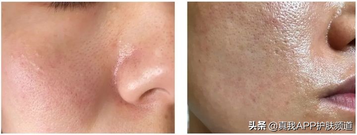 皮肤刷酸到底是什么意思,皮肤刷酸多久一次比较好