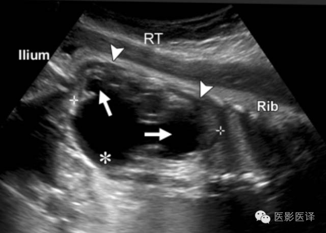 孕早期卵巢囊肿边界清形态规则,孕期卵巢囊肿呈液性伴点状回声