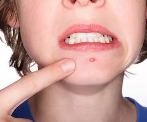 挤了三角危险区的痘痘头晕想吐,挤了个痘痘进icu