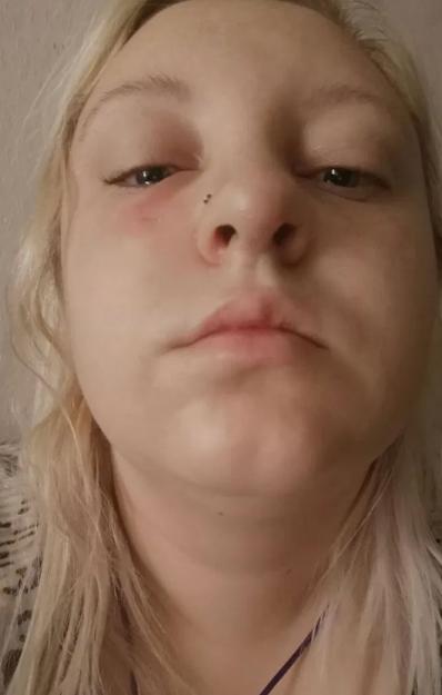 5岁女孩长水痘,成年人长水痘留下红印