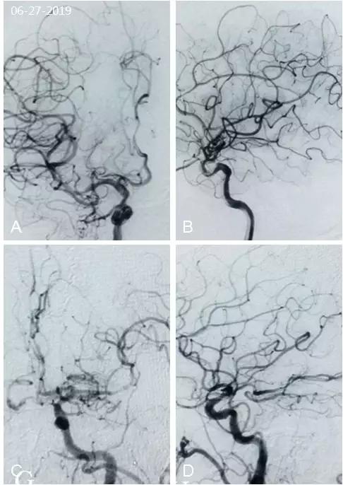 基底动脉狭窄介入指南,基底动脉重度狭窄用药用量