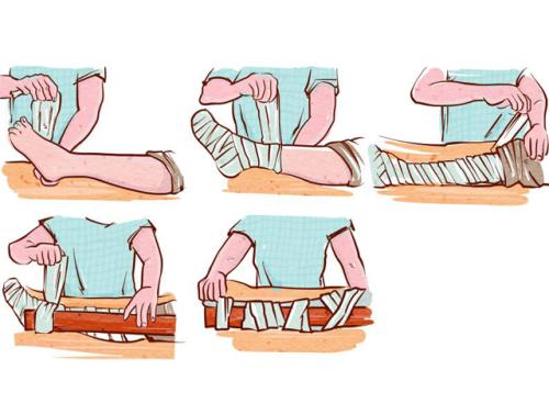 骨折后肿胀不能手术怎么办,骨折恢复过程中脚肿怎么办