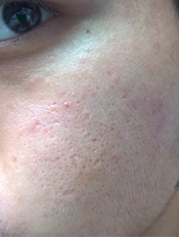 点阵激光能把伤疤完全修复吗,激光点阵可以修复到多少程度