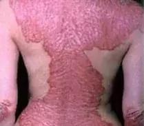 专治牛皮癣银屑病的外用药膏,治疗牛皮癣银屑病民间土方17种