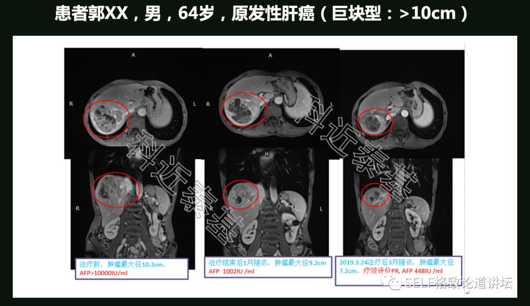 这个装置成功辅助我国两弹爆炸，现在它能治疗肿瘤