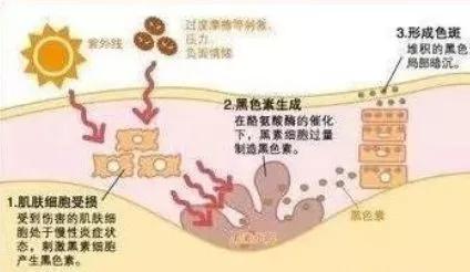 男生脸上的雀斑怎样快速去掉,小孩脸上有雀斑怎样才能去掉
