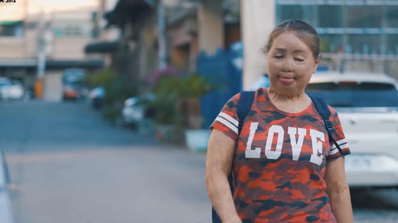 20岁小伙被重度烧伤七年后续,20岁严重烧伤毁容