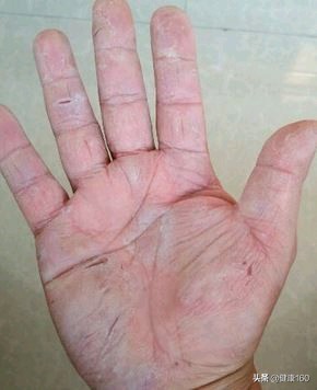 手脱皮考虑什么诊断,手脱皮有哪几种类型