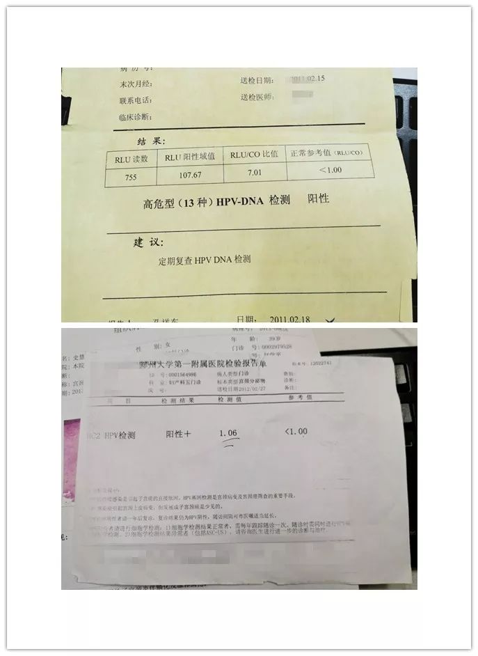 预防宫颈癌先从HPV下手