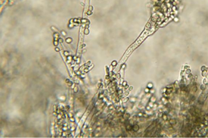 美国真菌感染传播,美国暴发超级真菌传染途径