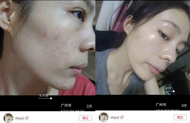 烂脸适合的护肤水,烂脸最好用的护肤品