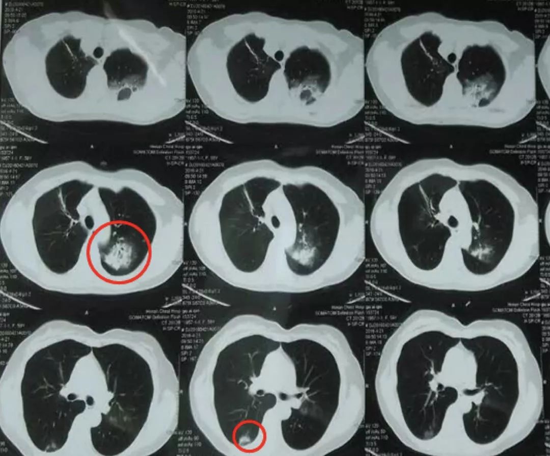 抗感染治疗后效果欠佳，感染非感染？TBLB和肺穿刺病理有哪些提示
