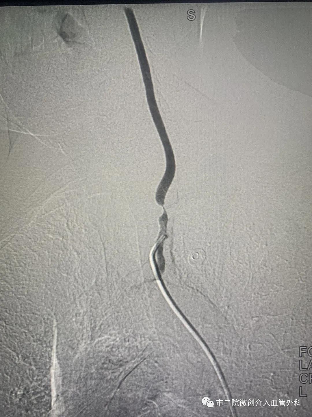 渭南二院血管外科专家,渭南市中心医院脑血管介入手术