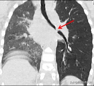 孩子支气管异物ct能查出吗,儿童支气管异物诊断方法
