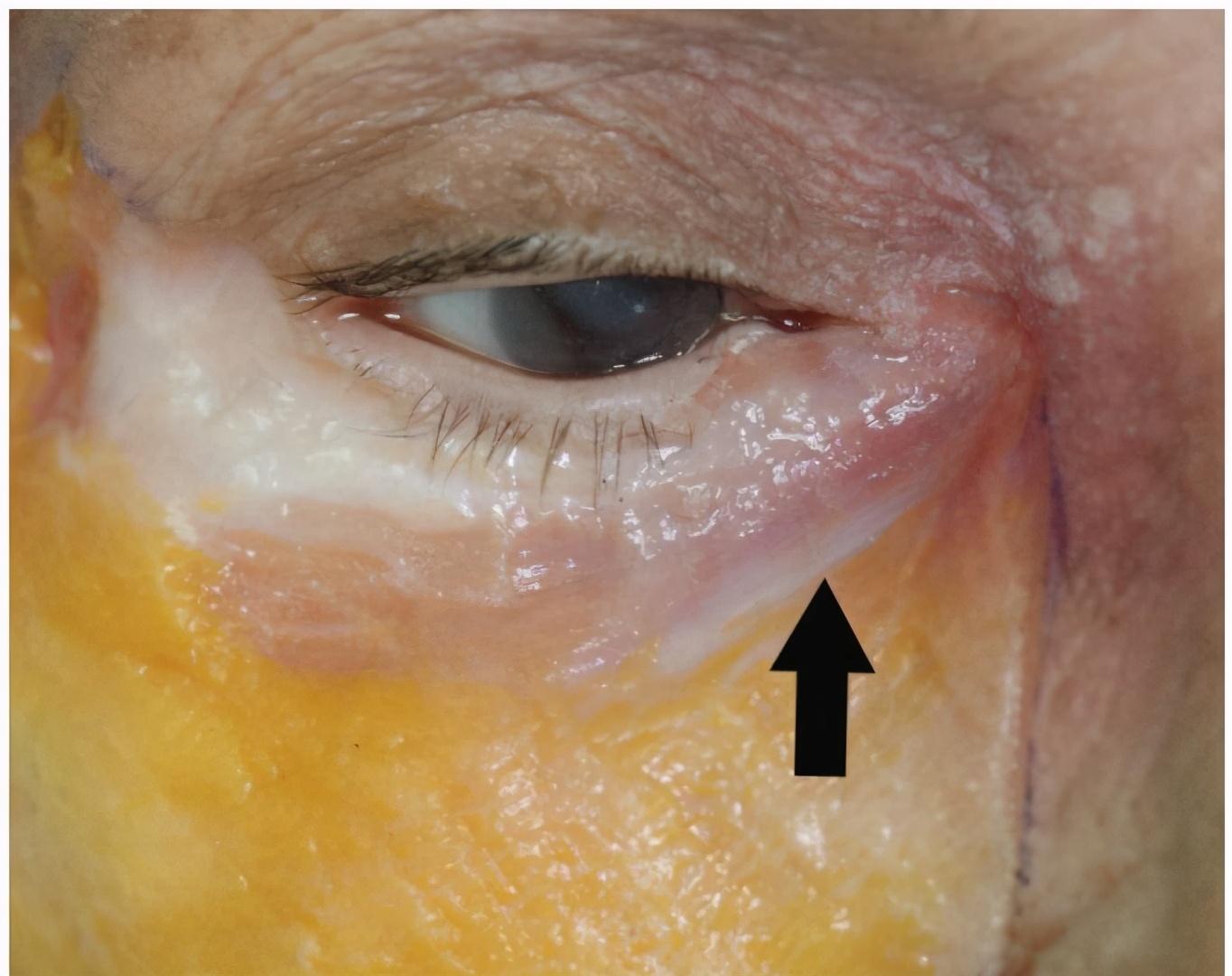 用盐和什么能去出眼袋,眼袋长肉粒怎么消除