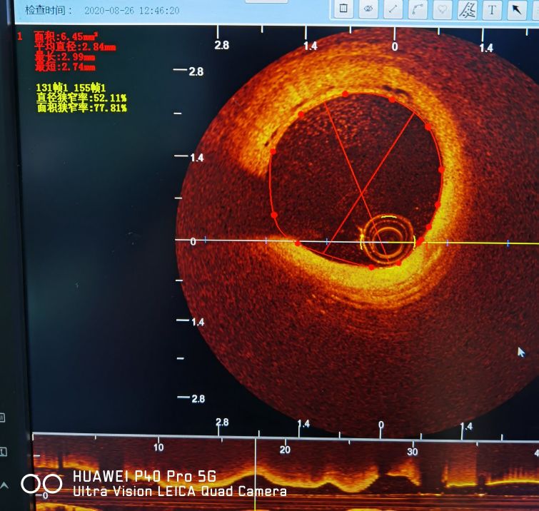 信阳市中心医院心脏射频消融手术,信阳中心医院心血管科室怎样