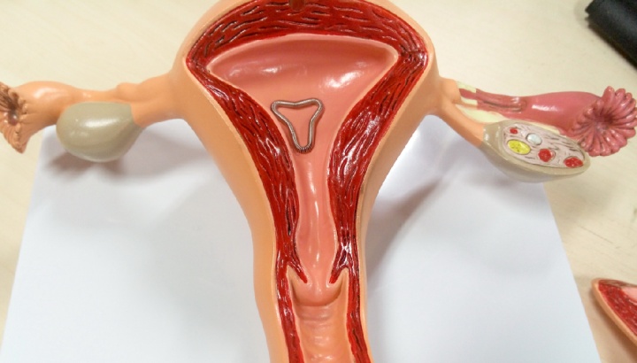 环节育器,避孕环和避孕器