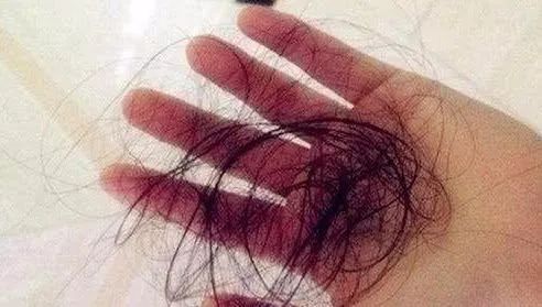 头顶脱发是肾精亏虚吗,头顶脱发是血虚