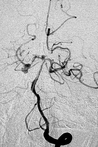 卢旺盛：脉瘤和基底动脉动脉瘤裸栓治疗术后效果非常明显