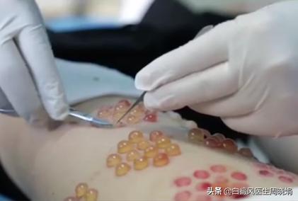 白斑植皮手术,白斑做手术