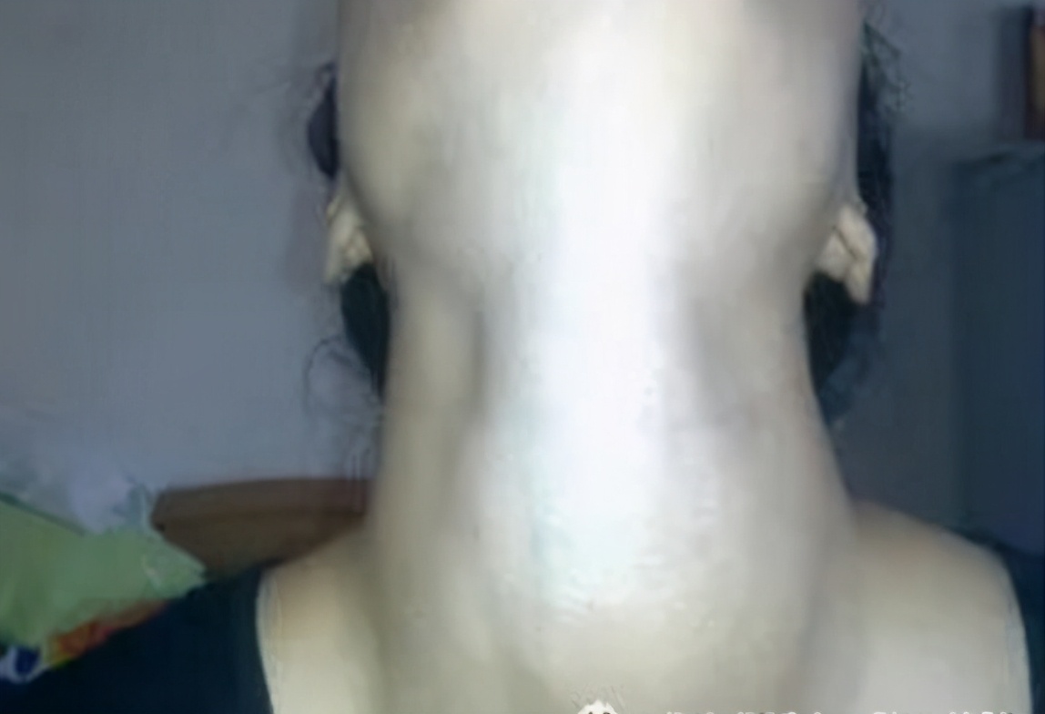 甲状腺肿大的危害有多大,甲状腺肿大压迫气管有哪些危害