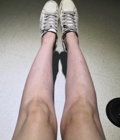 牛皮癣患者的治愈经历,牛皮癣患者亲身治愈经历