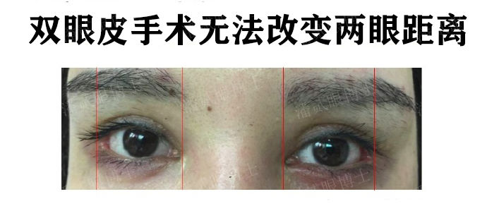 在原有双眼皮的基础上割双眼皮,割双眼皮不知道开扇形还是平行形