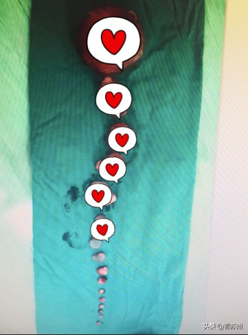 子宫肌瘤像鹅蛋那么大,鸡蛋一样大的子宫肌瘤