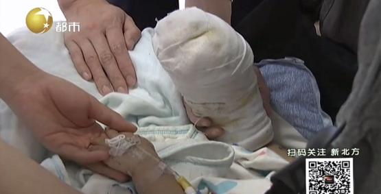 一岁宝宝被开水烫伤后皮肤发红,宝宝被开水烫伤破皮放了酱油