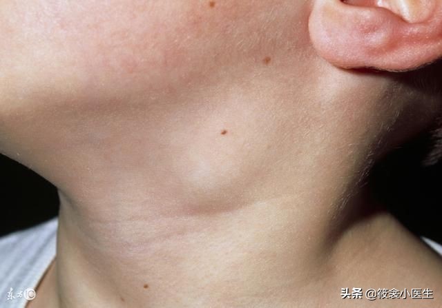 少儿川崎病,川崎病是什么样子的儿童