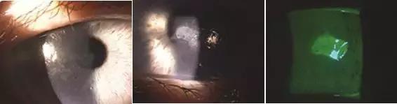 干眼症为什么要查过敏原,怎么判断是过敏还是干眼