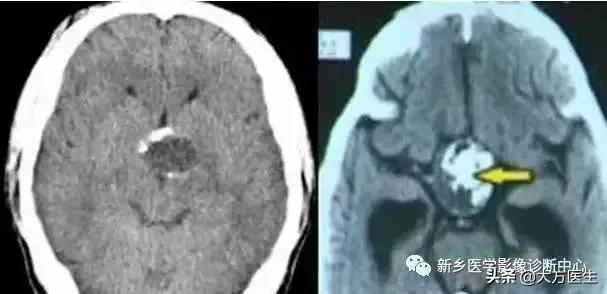 钙化灶是良性肿瘤的可能性大吗,颅内肿瘤钙化发生率最高