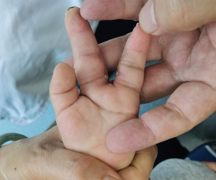 并指畸形免植皮案例,并指畸形