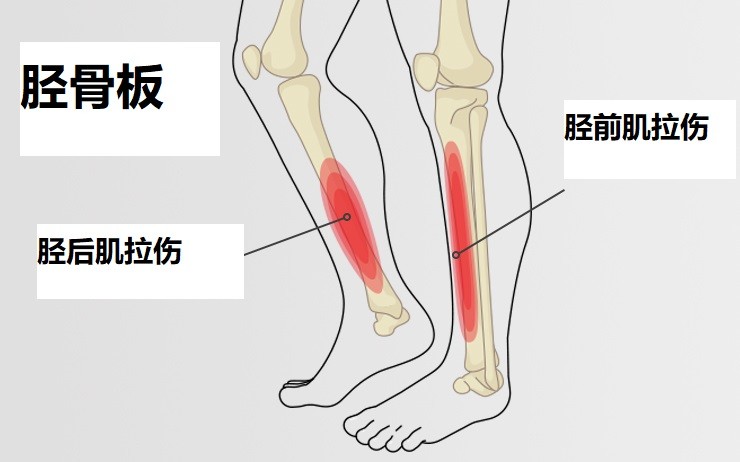 小孩没运动小腿痛是什么原因,孩子没走几步就说腿累了怎么回事