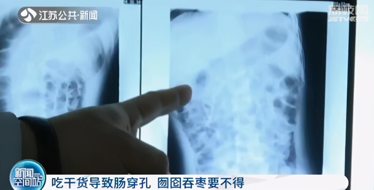 吃坚果类拉肚子,吃坚果会闹肚子吗