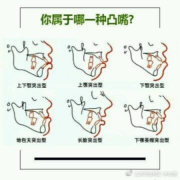 如何判断自己龅牙是不是骨性,怎样判断龅牙是牙性还是骨性