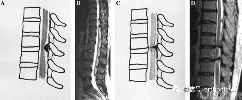 胸椎怎么做微创,脊柱内镜微创操作流程
