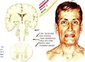 家用指甲钳拔牙,拔牙感染险些丧命