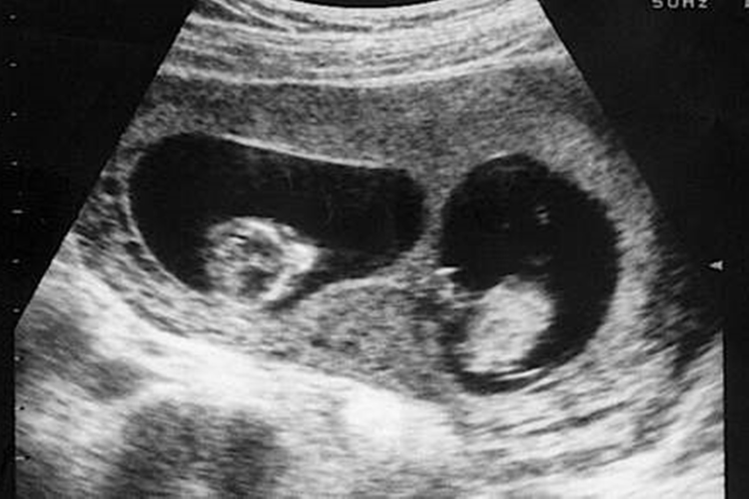 龙凤胎姐姐腹中被“吸收”，弟弟出生后腿上胎记引关注，让人动容