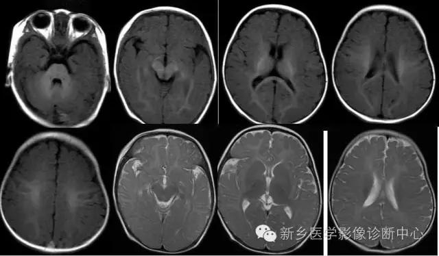 脱髓鞘样改变的mri表现,髓鞘形成稍延迟区
