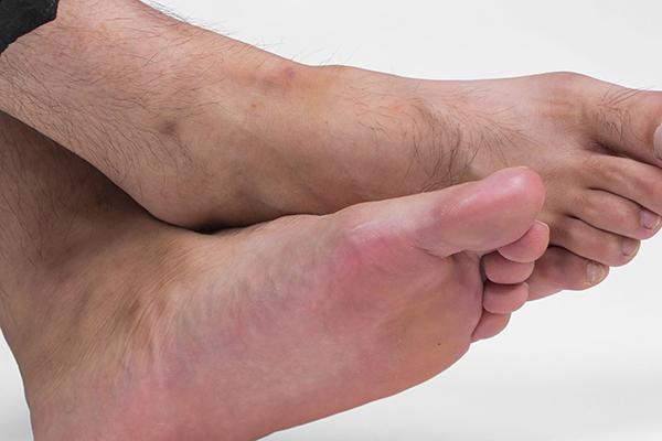 脚趾甲侧面嵌甲自己怎么处理,脚指甲剪得太深嵌甲怎样预防