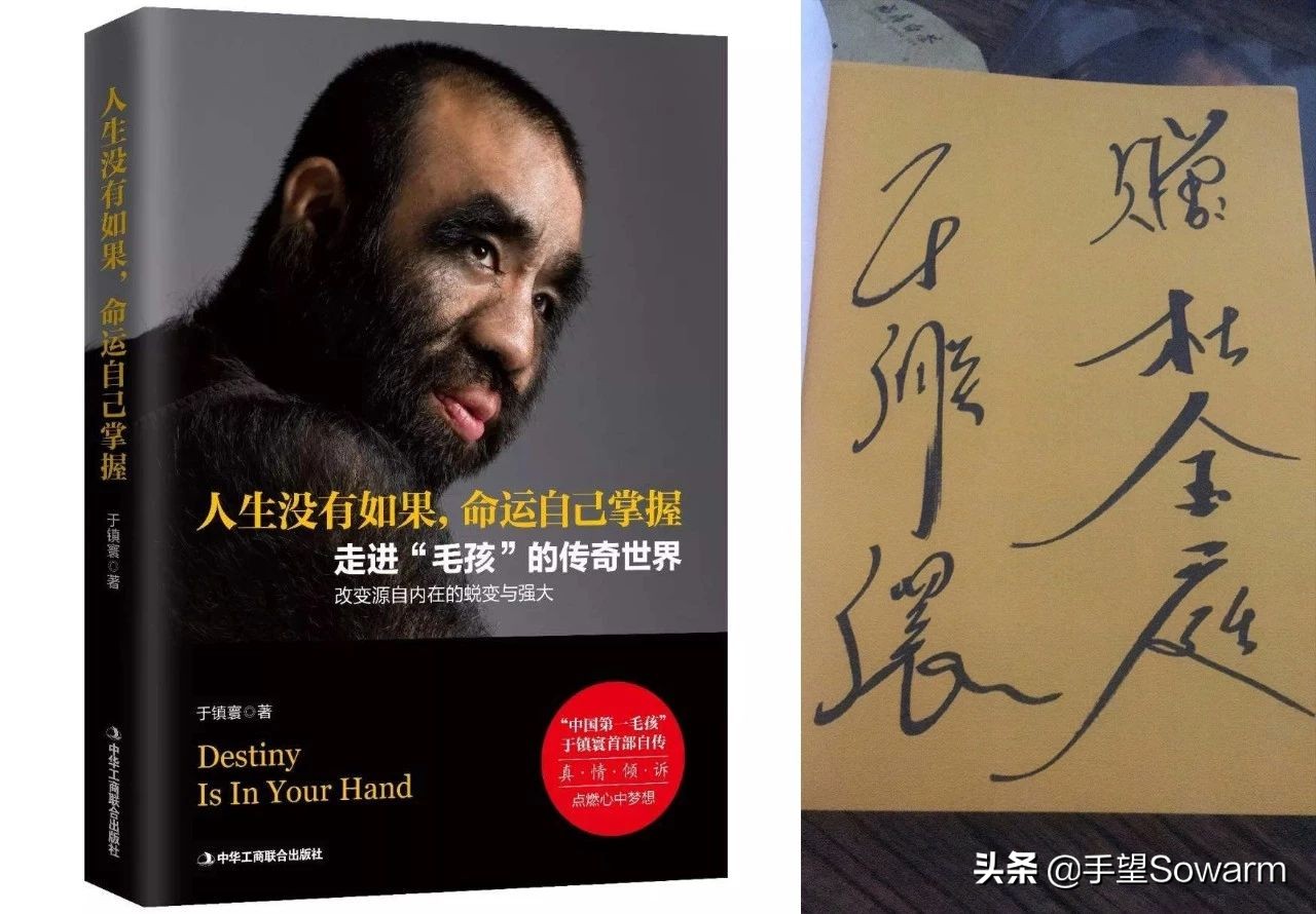 全世界体毛最多的人，是如何在歧视中逆袭为实力派歌手的？