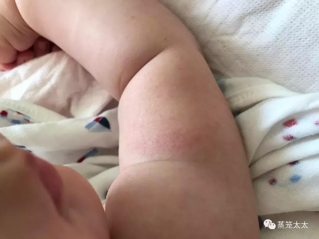 干性湿疹怎么护理和治疗,手湿疹怎么治疗和护理