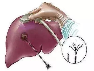 肝囊肿要治疗吗什么原因引起,肝囊肿14x13mm要不要紧